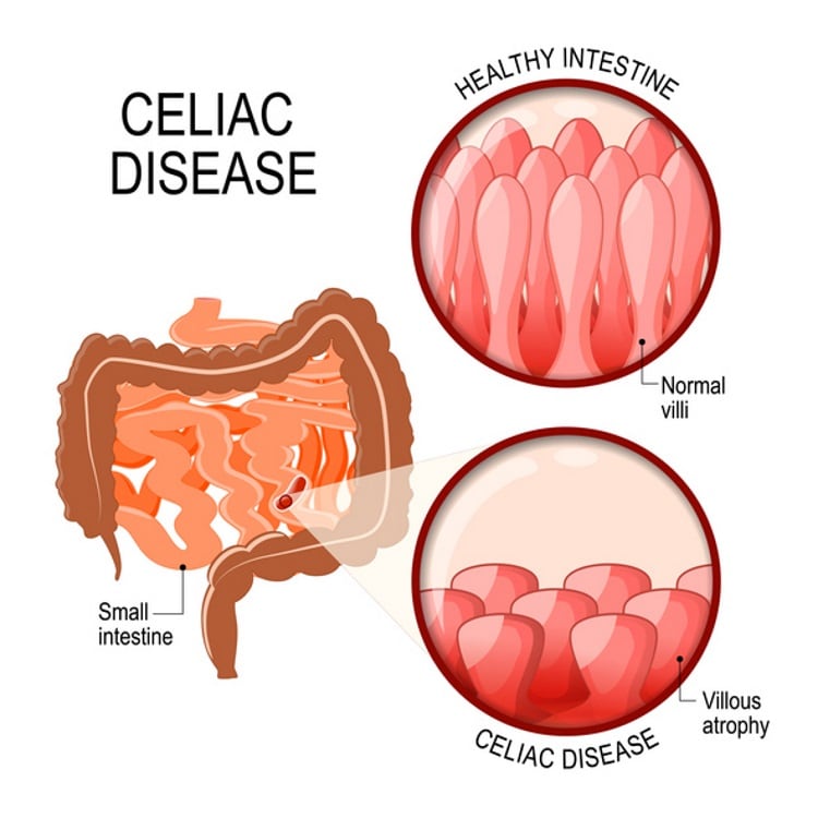 Celiac-diseas-Getty.jpg