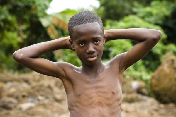 Malnourished African boy himarkley